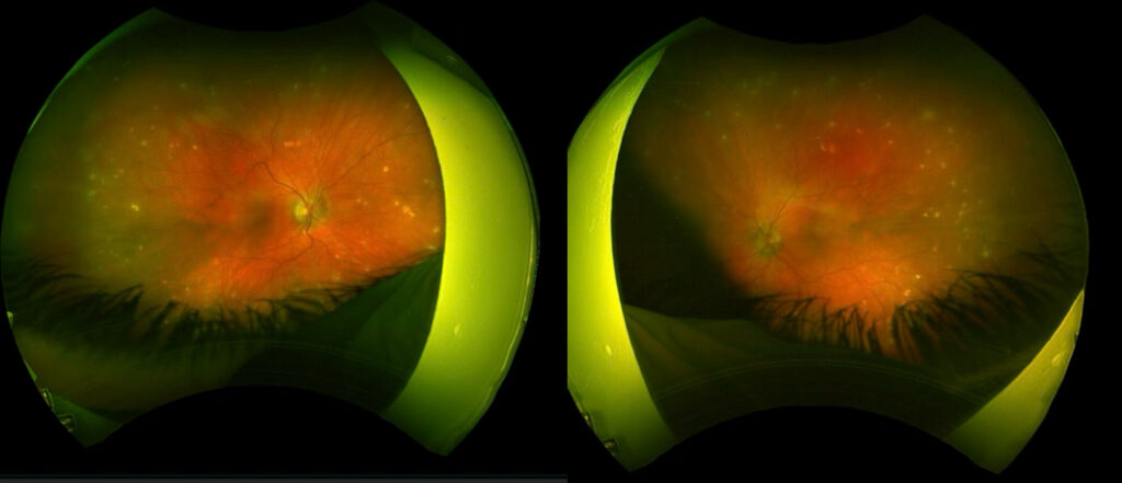 Multifocal choroiditis