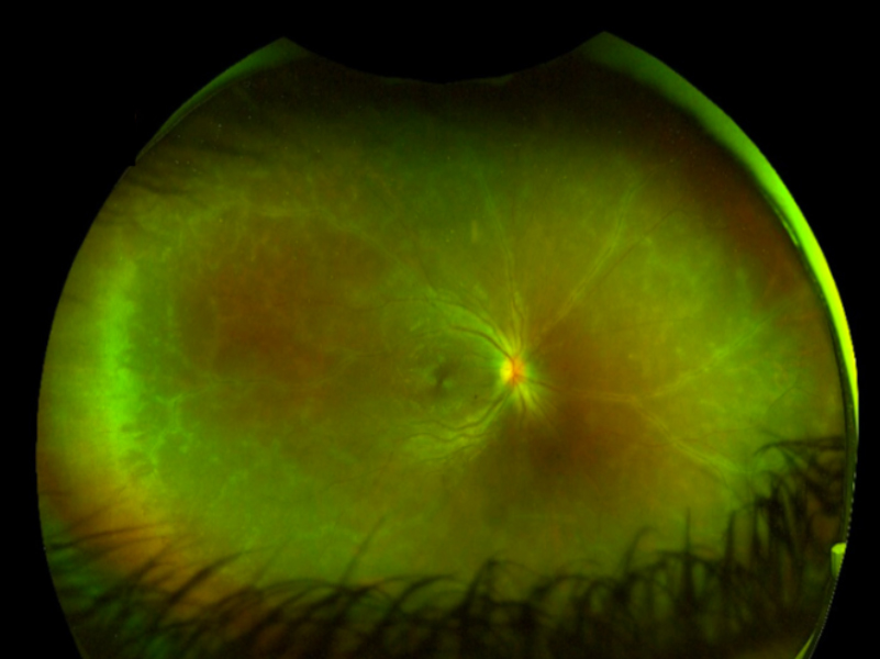 Retinal vasculitis