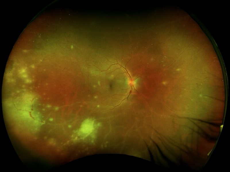 Viral retinitis
